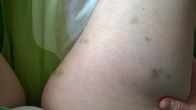 purple bruises across a woman's skin
