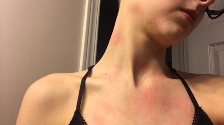 red blotches across a woman's neck and chest