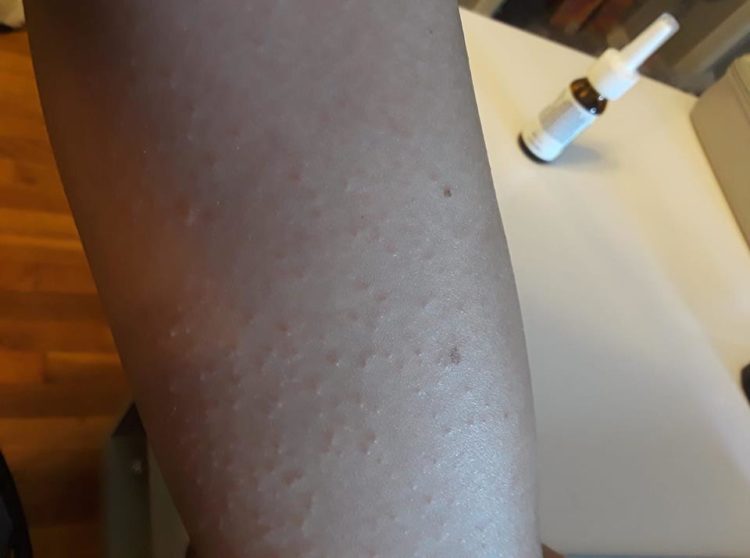 small bumpy rash on a woman's arm