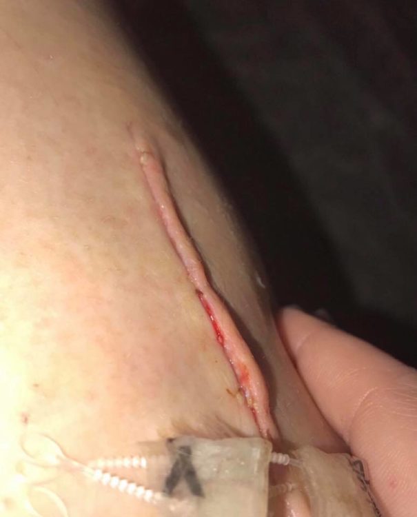 thick raised scar by surgical incision