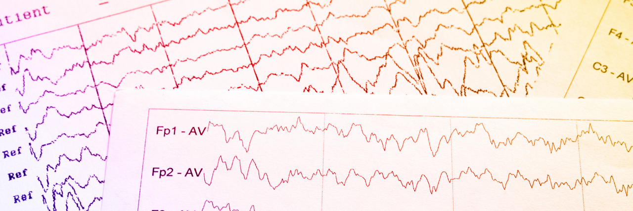 Study Links Brain Activity in Hippocampus, Amygdala to Depression Two pages of EEG data