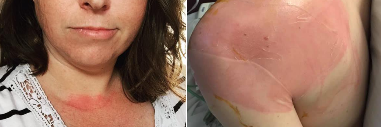 22 Photos That Show What Mast Cell Activation Disorder Looks Like woman with a red rash across her chest and woman with red rash on her shoulder