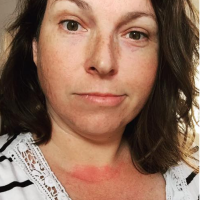 woman with a red rash across her chest and woman with red rash on her shoulder