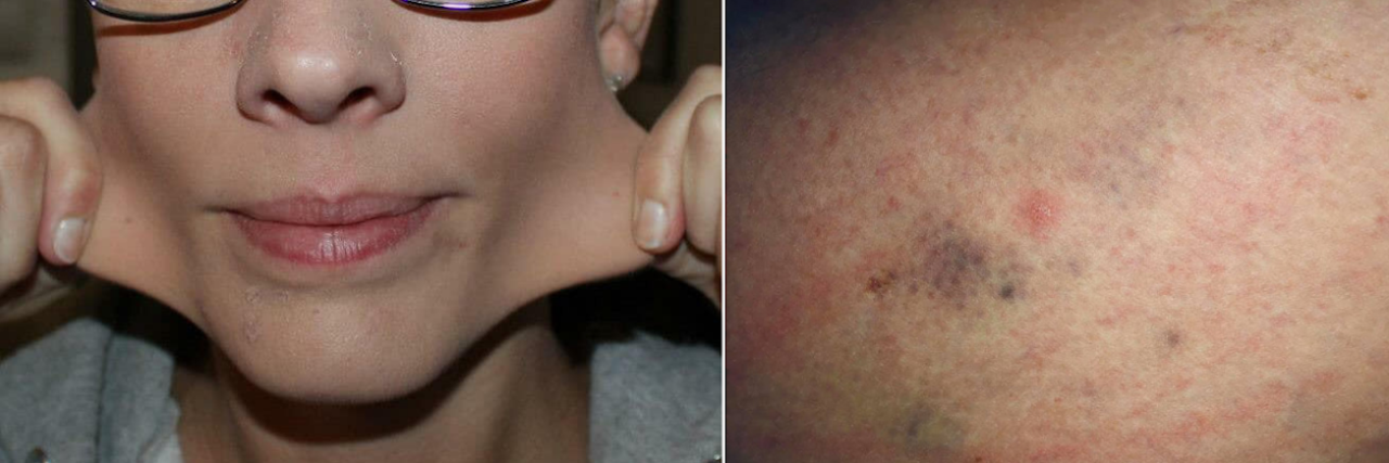 23 Photos That Show How Ehlers-Danlos Syndrome Affects the Skin left photo: woman stretching the skin on her cheeks. right photo: redness and bruising on a woman's skin