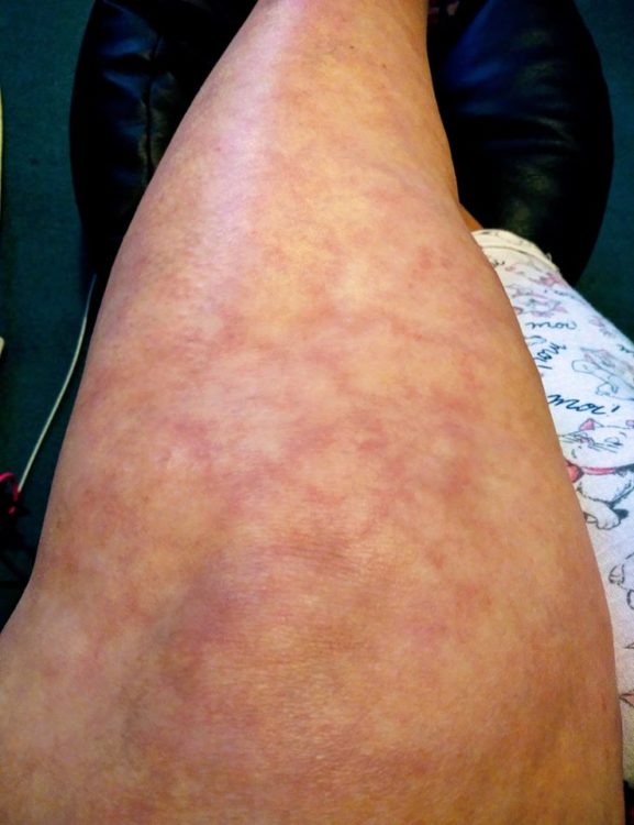 livedo reticularis rash on a woman's leg