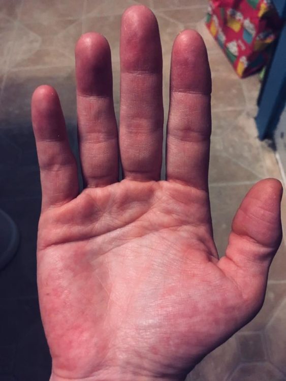 a person's hand looking very red