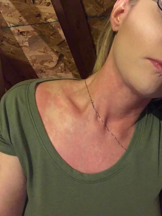 woman showing blotchy neck of hives