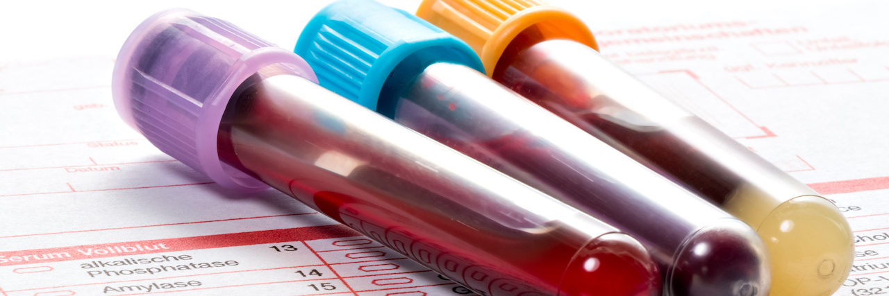 FM/a, IsolateFibromyalgia Blood Tests Claim to Diagnose Fibromyalgia Blood samples are on a laboratory form for Finding out the blood values
