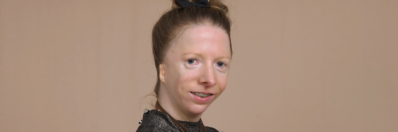 Accepting My Craniofacial Disability Cynthia Murphy wearing a black sleeveless dress.