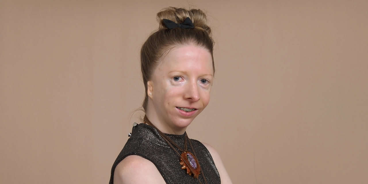 Head Disability Learning to Love Myself as Someone With a Craniofacial Disability