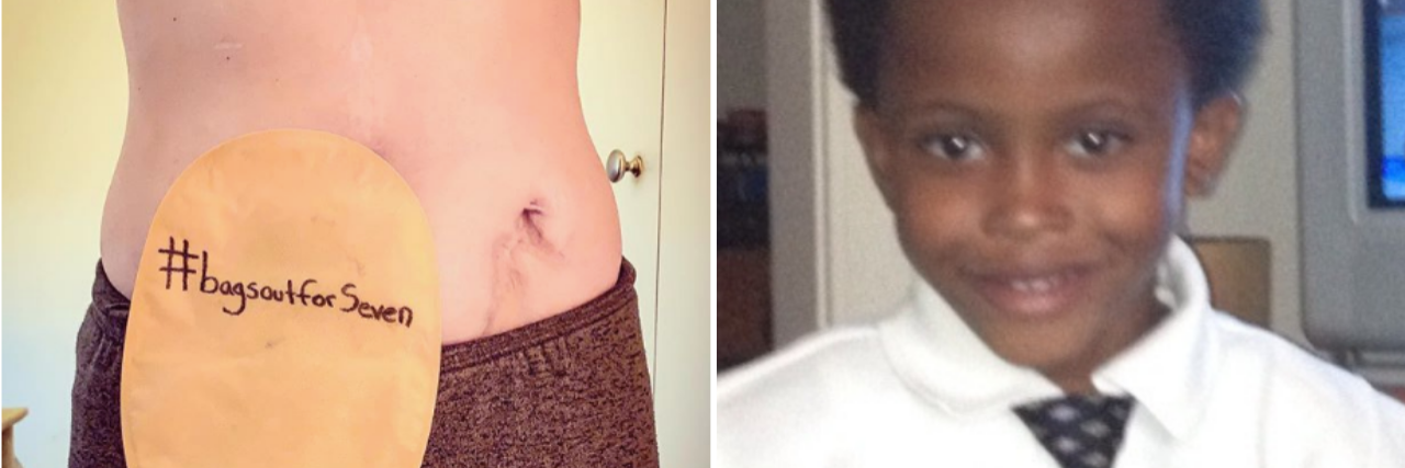 left photo: woman's ostomy bag with the hashtag bagsoutforseven. right photo: seven bridges wearing a collared shirt and tie