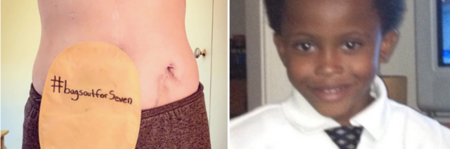 left photo: woman's ostomy bag with the hashtag bagsoutforseven. right photo: seven bridges wearing a collared shirt and tie