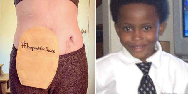 left photo: woman's ostomy bag with the hashtag bagsoutforseven. right photo: seven bridges wearing a collared shirt and tie