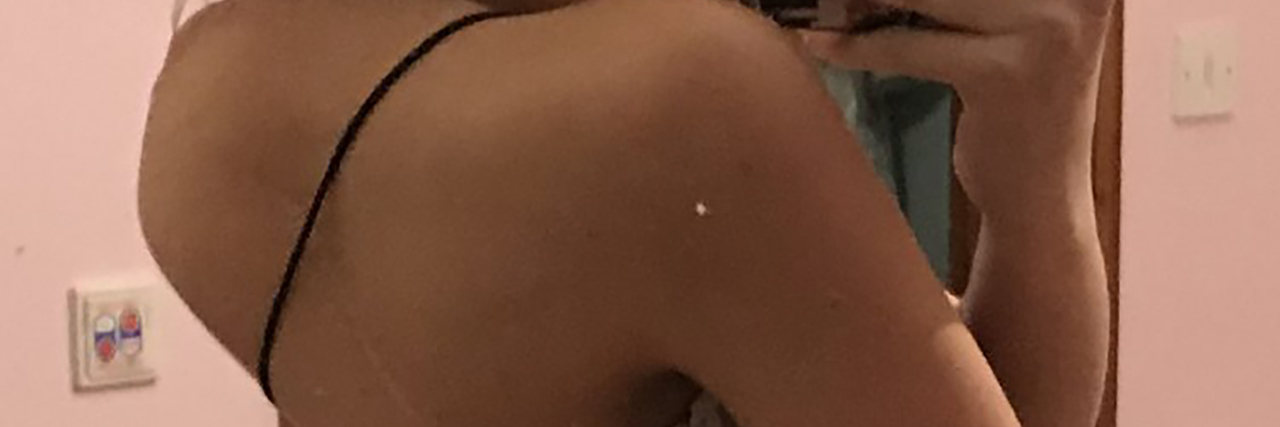 Accepting My Kyphosis Katie's selfie showing her kyphosis.