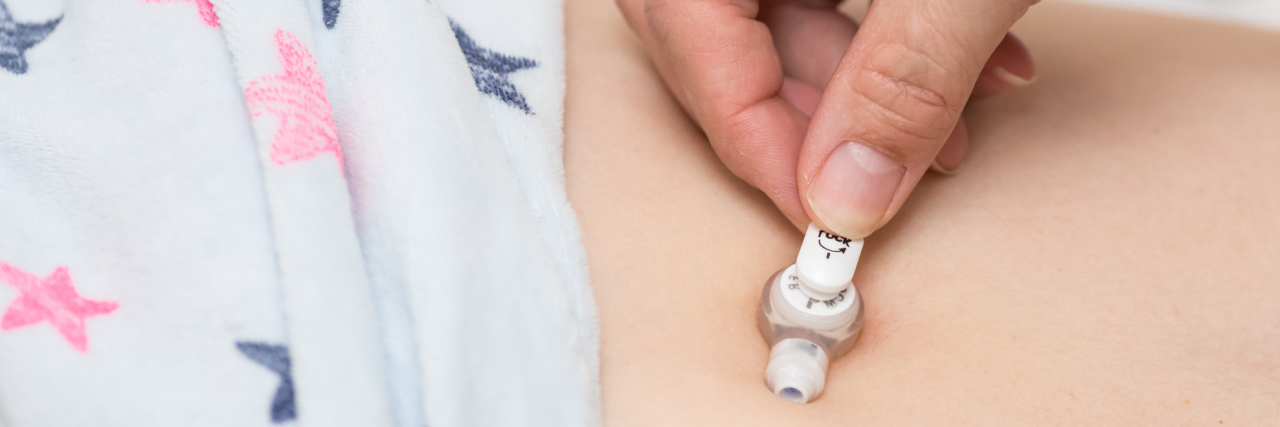 Why I'm Thankful for My Feeding Tube nurse placing feeding tube in a woman's abdomen