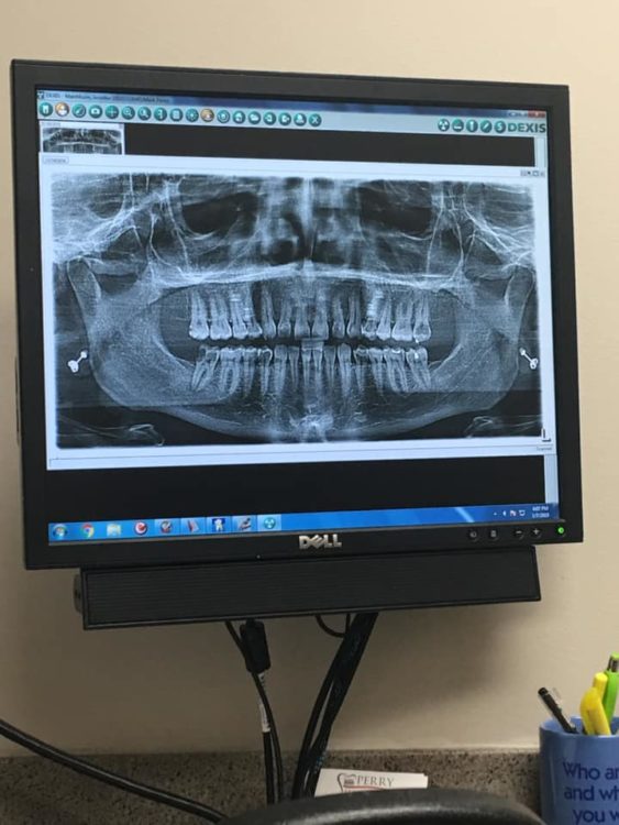 A photo of someone's dental x-ray in a dentist's office.