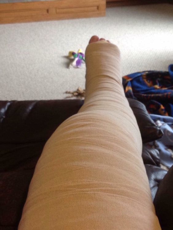 wrapped leg from swelling