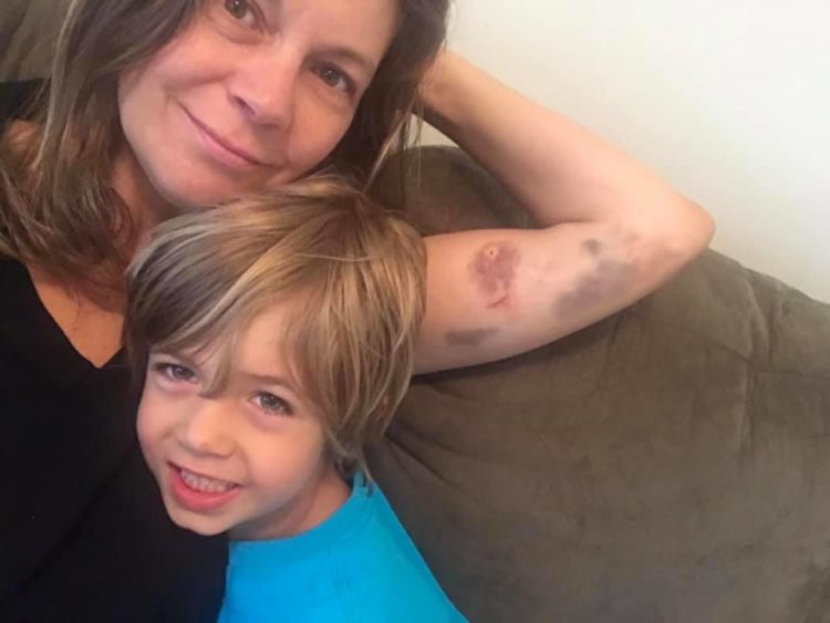 woman bruising arm with son