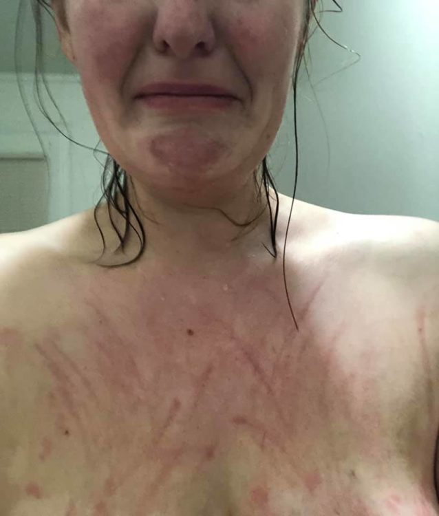 woman scratches body hives