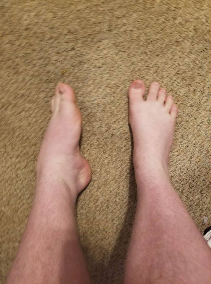 man with rolled ankle due to ehlers-danlos syndrome