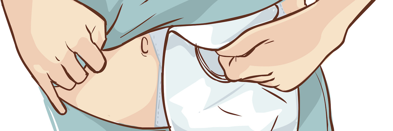 Useful Tips for Anyone Who's New to an Ostomy illustration of a ostomy bag