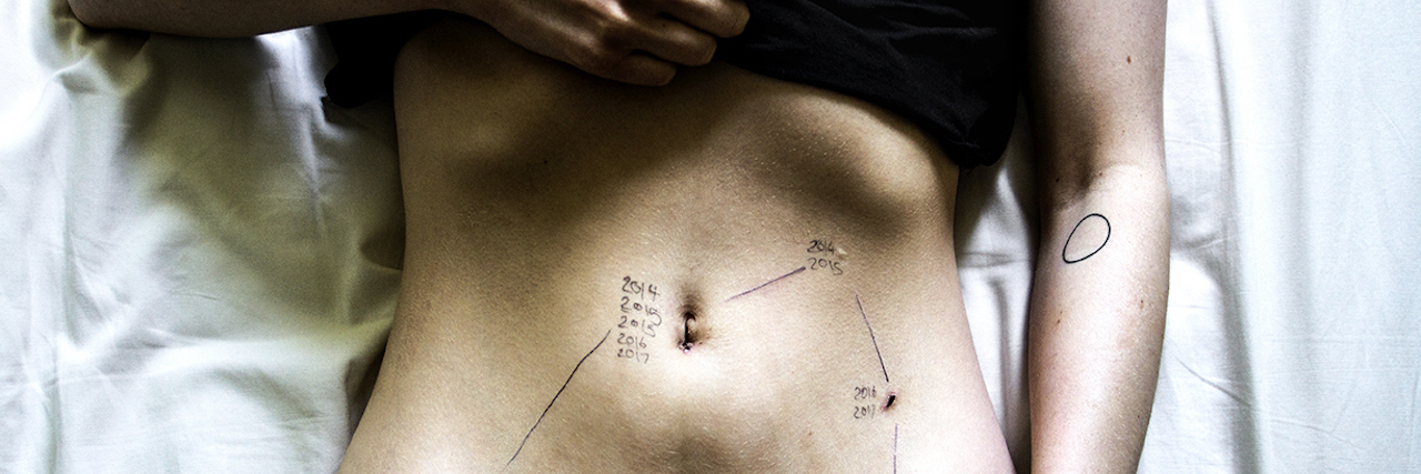 Georgie Wileman Starts #ThisIsEndometriosis Social Campaign Georgie Wileman's This Is Endometriosis series