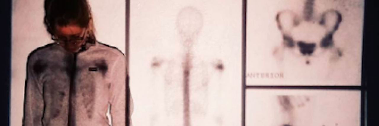 Living With Chronic Recurrent Multifocal Osteomyelitis: What to Know