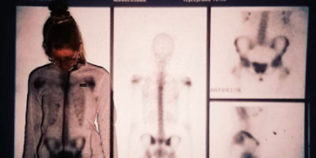 The Battle of Living With a Rare Autoimmune Disease