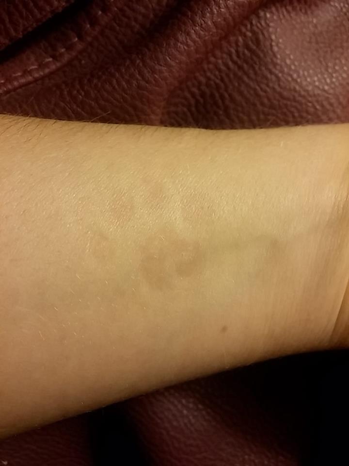 imprint of kitten paw on woman's arm from dermatographia