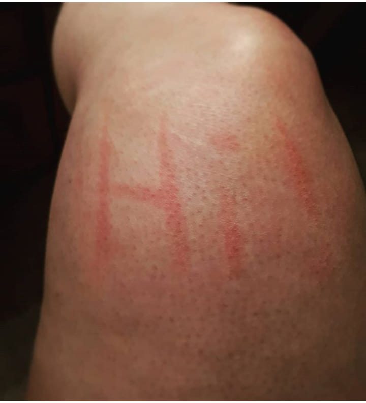 deep red marks that write 'hi!' on a woman's leg from dermatographism