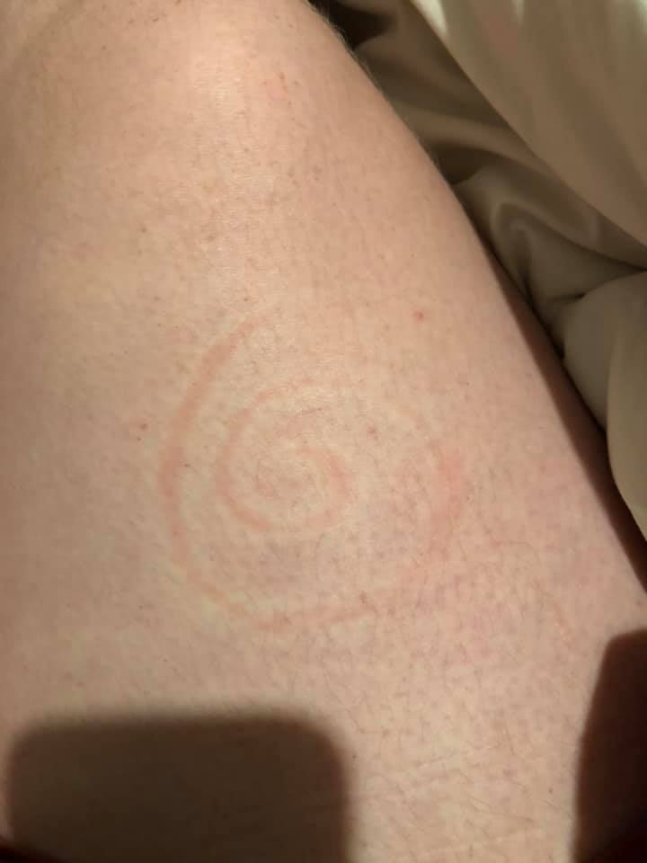 red marks on a woman's arm in the shape of a spiral from dermatographism