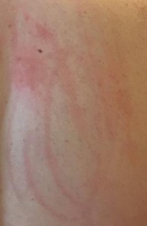 red welts and scratches on woman's skin from dermatographism
