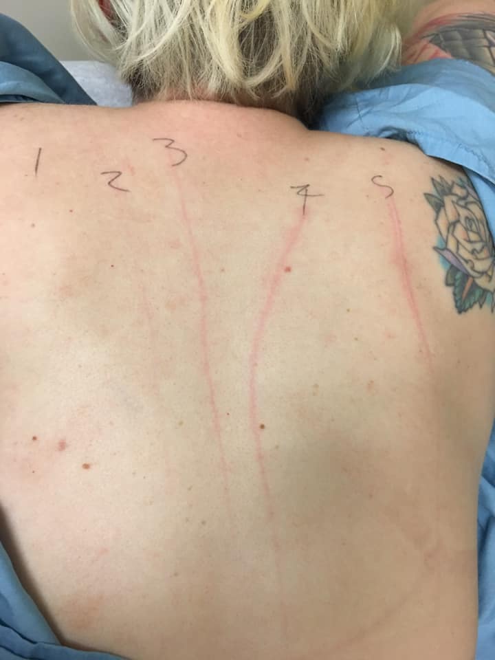 woman with five red welts running in lines down her back from dermatographism