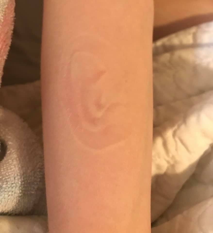 imprint on woman's arm from dermatographia