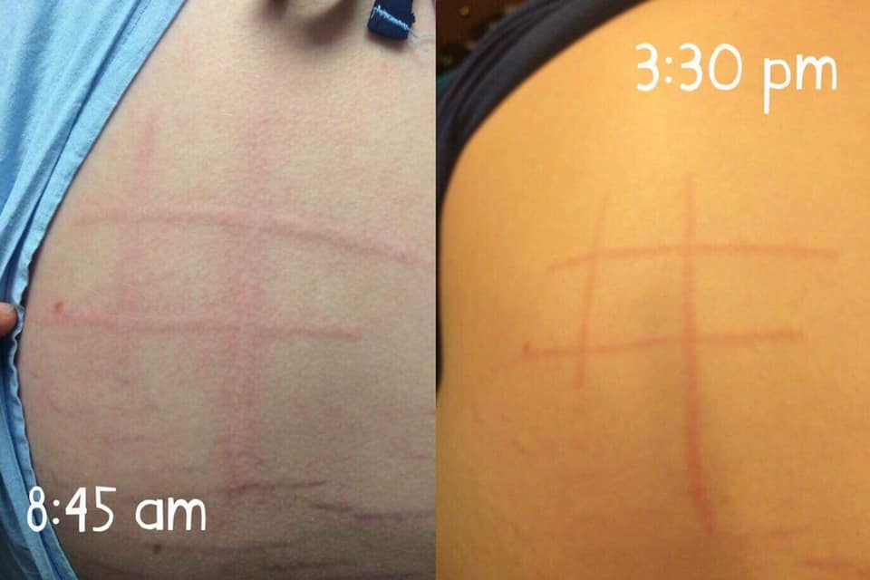 red welts in the shape of tic tac toe lines on a woman's back from dermatographism
