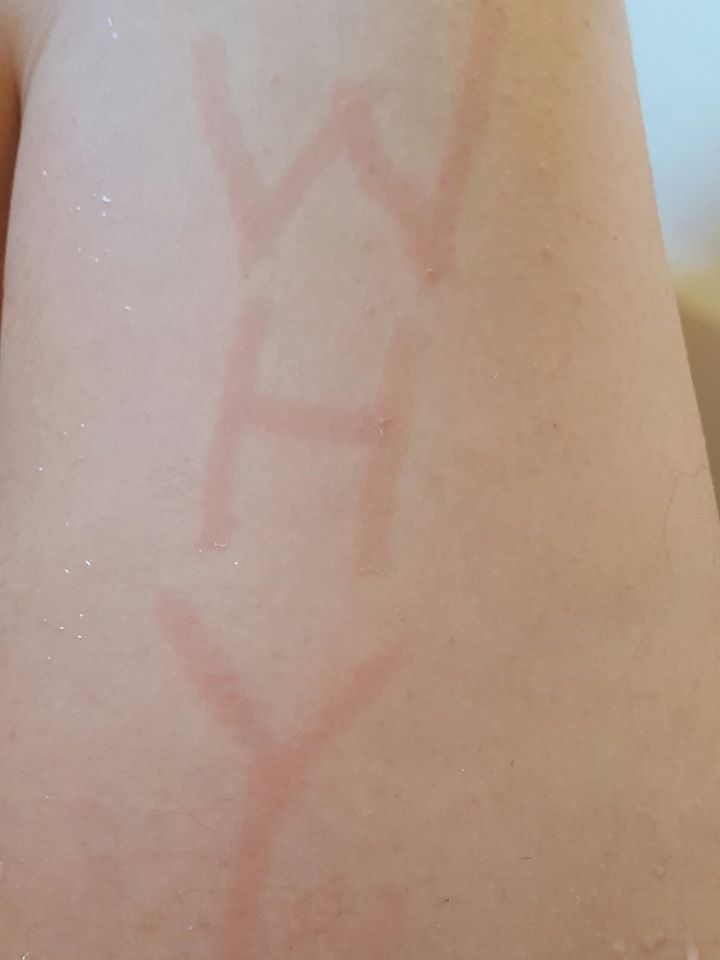 the word 'why' marked onto a man's skin in red welts due to dermatographism