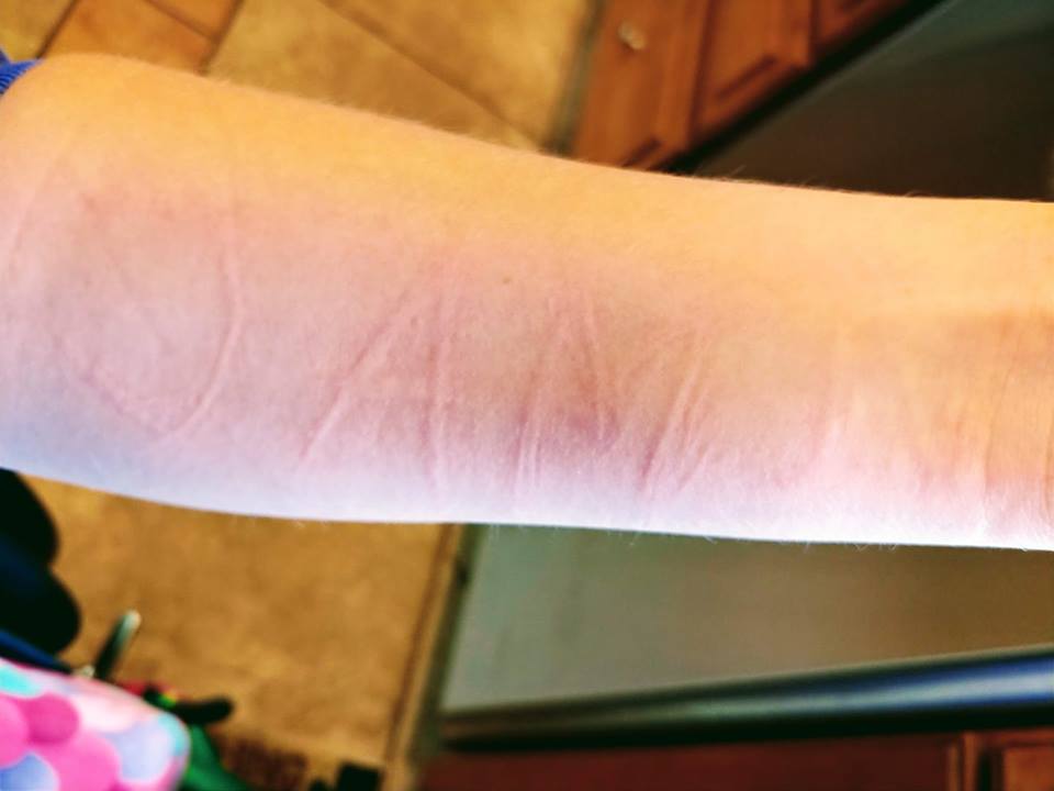 red welts on woman's arm that spell out 'Jamie' from dermatographism