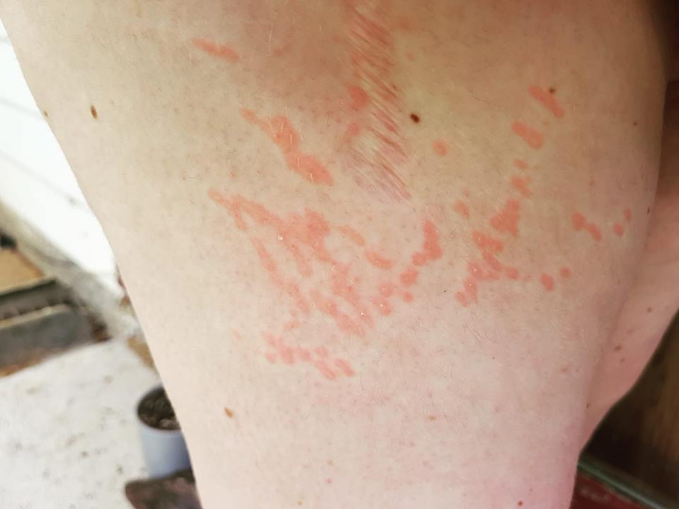 raised red dots in a rash on woman's skin from dermatographism