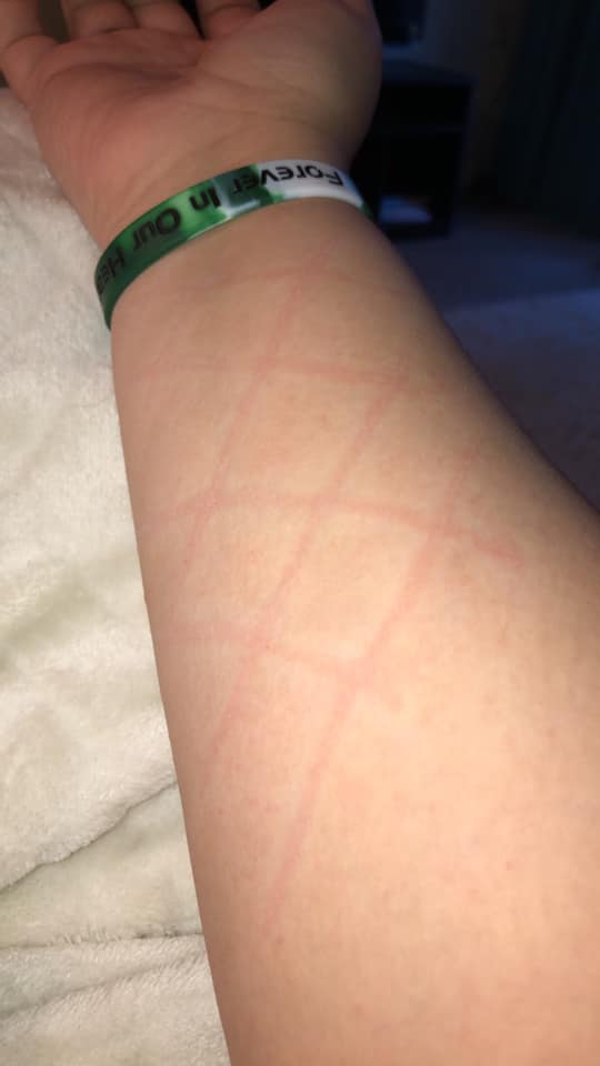 red marks in criss-cross pattern on woman's arm from dermatographism