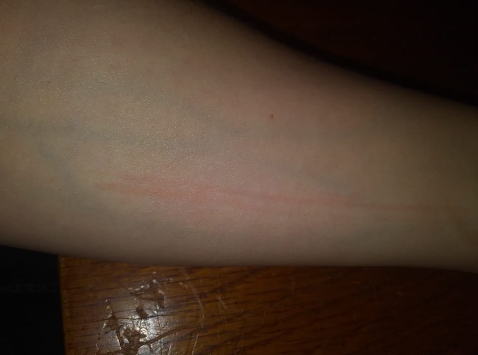 red scrape on woman's arm from dermatographism