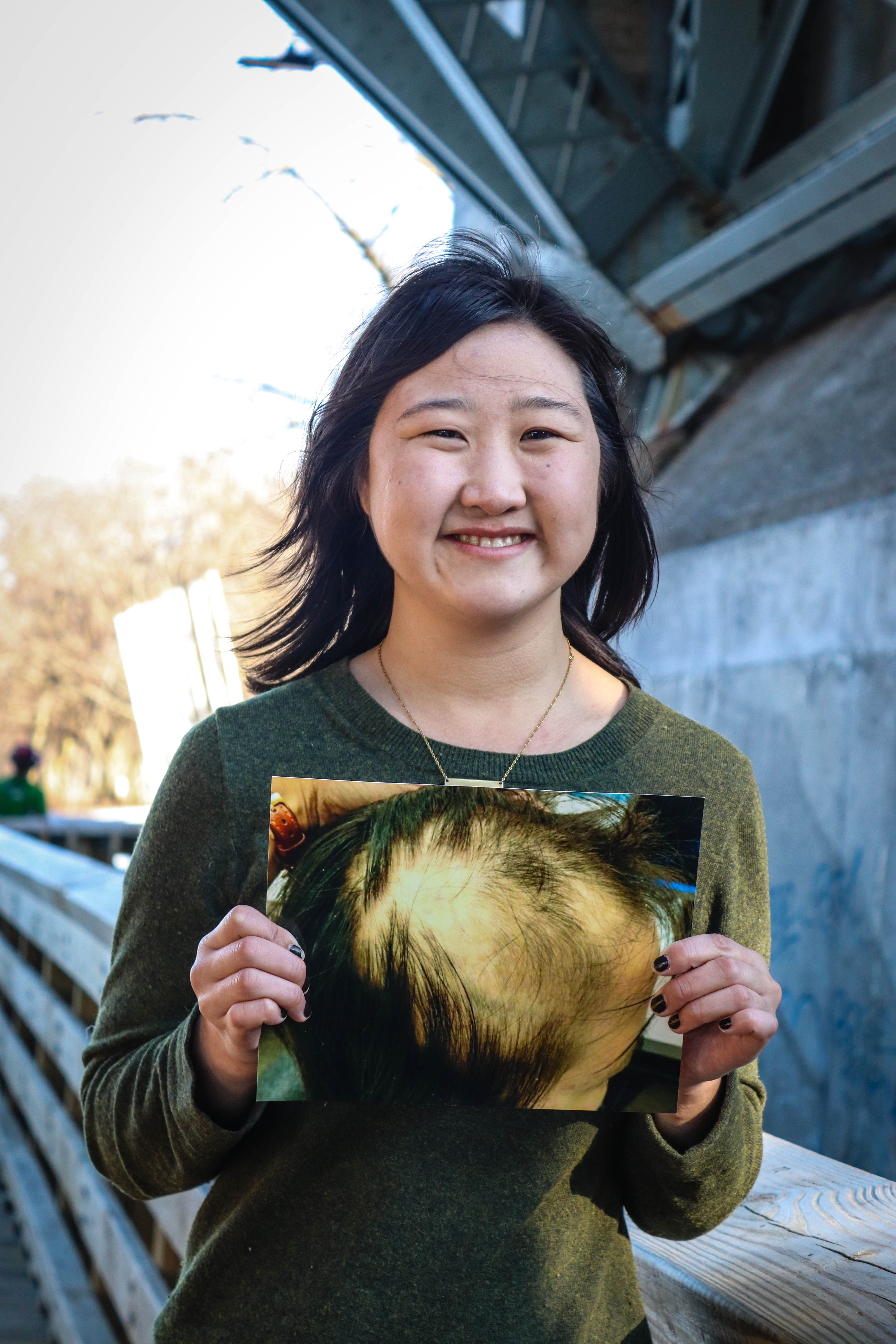 Sarah holding a photo of her scalp when she was balding due to alopecia areata.