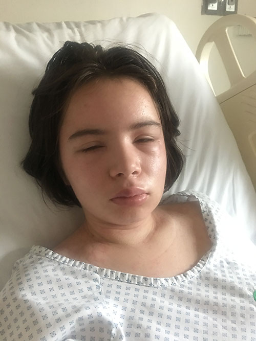 Julia laying in a hospital bed, her face completely swollen.