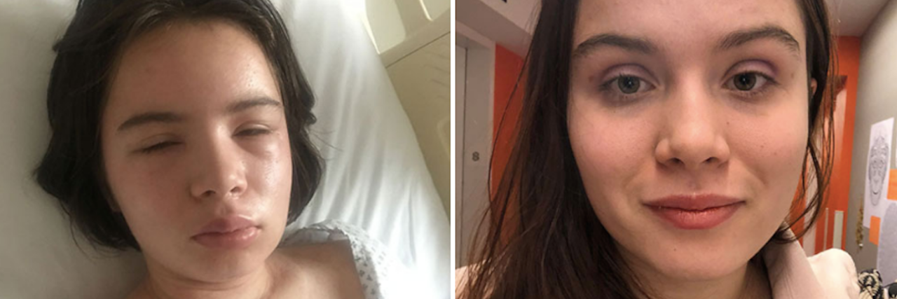 Autoimmune Disease Caused Body Dysmorphic Disorder Split screen of Julia in the hospital and Julia now.