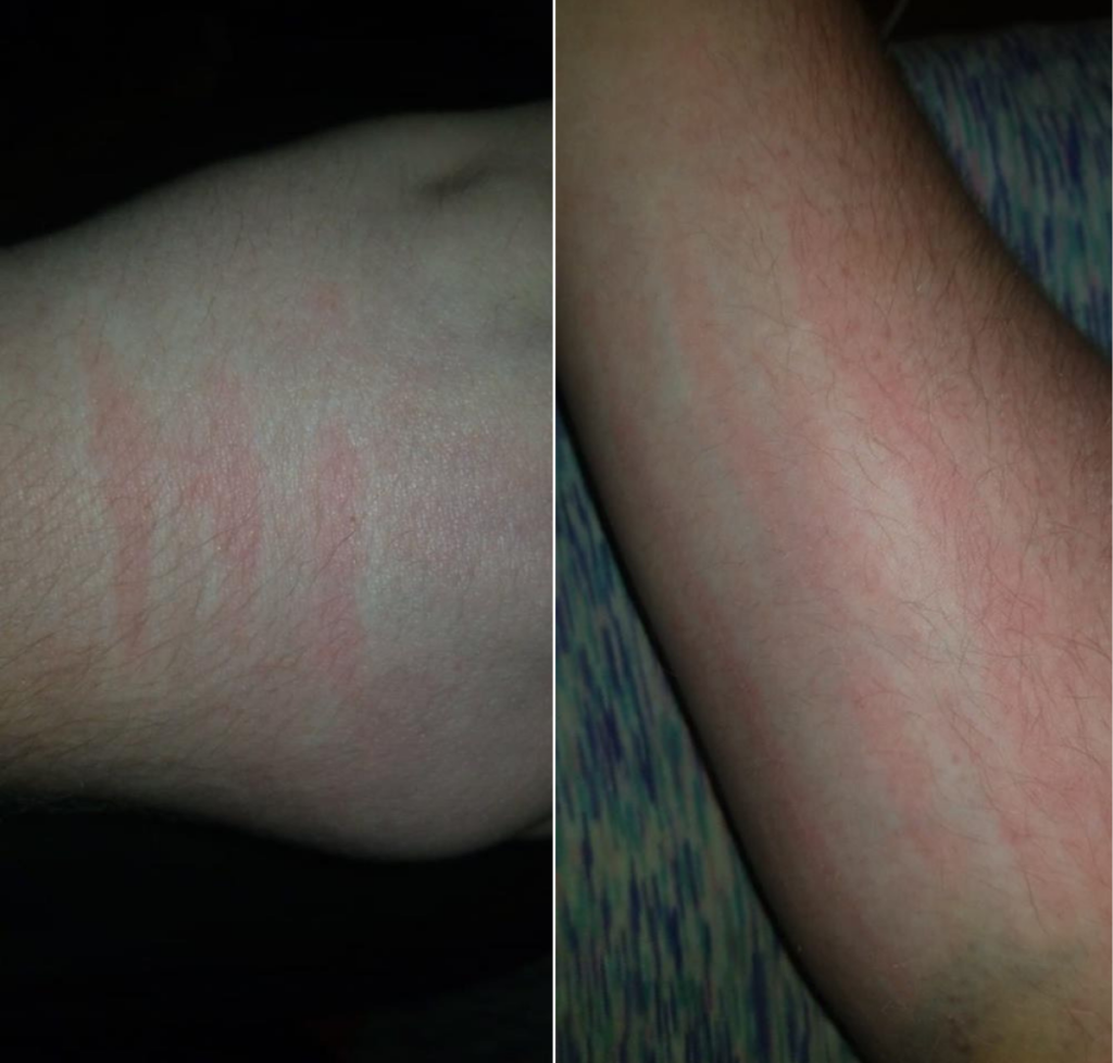 red welts and indentations on a man's arm from dermatographism