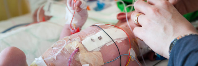 a baby recovering in the ICU after a heart surgery
