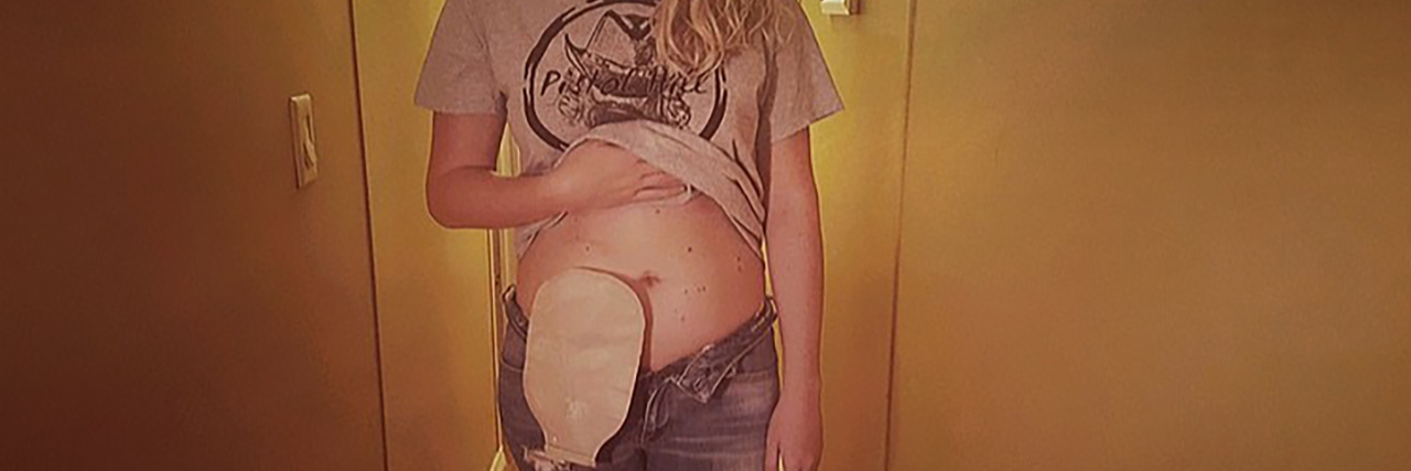 Tips for Road Trips and Traveling With an Ostomy