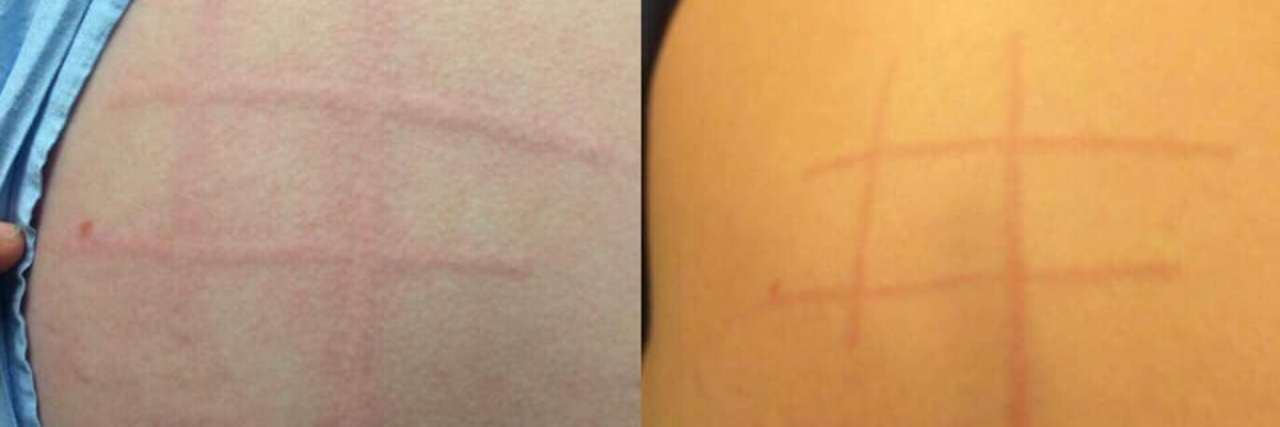 raised red welts in tic-tac-toe pattern on woman's back from dermatographism