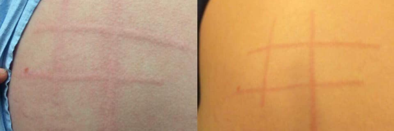 16 Photos of Dermatographism raised red welts in tic-tac-toe pattern on woman's back from dermatographism