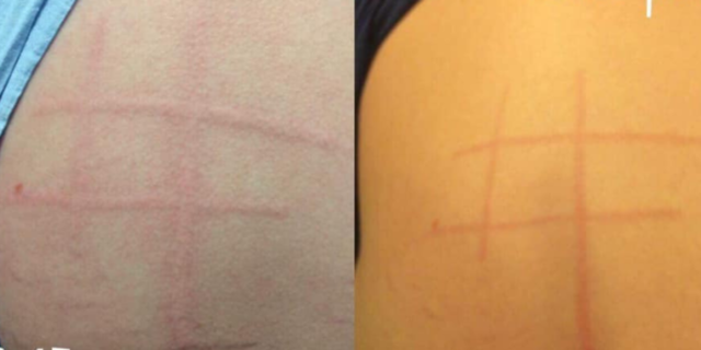 raised red welts in tic-tac-toe pattern on woman's back from dermatographism
