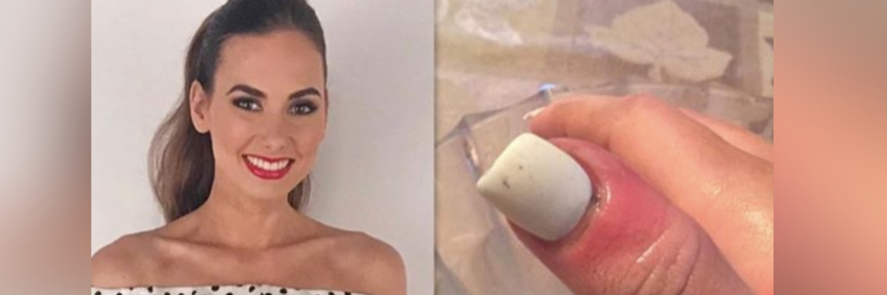 Former Miss Illinois Karolina Jasko Shares Photo of Nail Melanoma